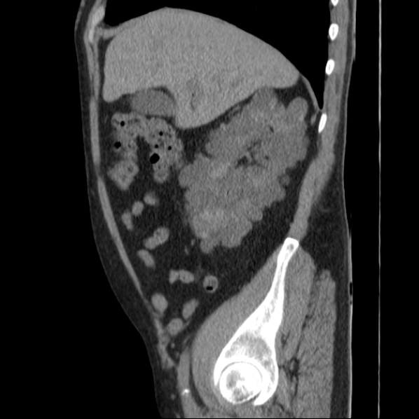 File:Autosomal dominant polycystic kidney disease (Radiopaedia 36539-38101 D 25).jpg
