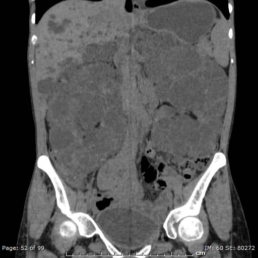 File:Autosomal dominant polycystic kidney disease (Radiopaedia 44122-47684 Coronal 1).jpg