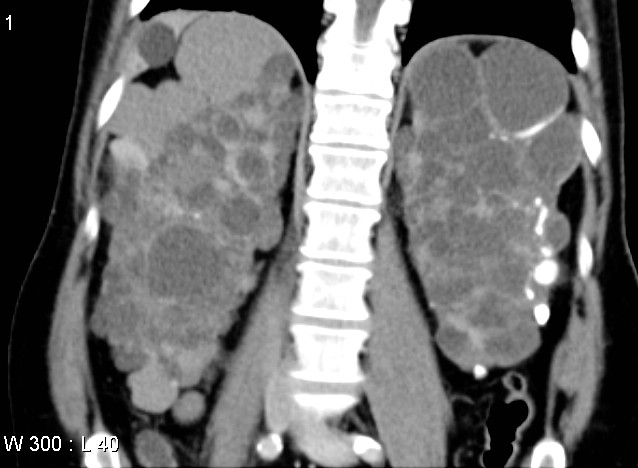 File:Autosomal dominant polycystic kidney disease (Radiopaedia 5203).jpg