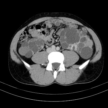 Autosomal dominant polycystic kidney disease (Radiopaedia 66349-75582 B 64).jpg