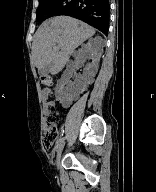 Autosomal dominant polycystic kidney disease (Radiopaedia 87830-104287 C 26).jpg
