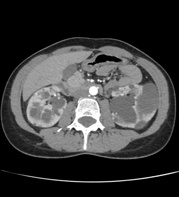 Autosomal dominant polycystic kidney disease - early onset (Radiopaedia 40734-43387 B 29).jpg