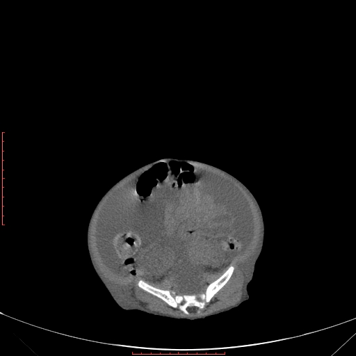 Autosomal recessive polycystic kidney disease associated with Caroli disease (Radiopaedia 61932-69984 Axial non-contrast 293).jpg