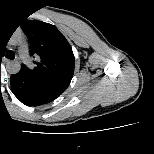 File:Avascular necrosis after fracture dislocations of the proximal humerus (Radiopaedia 88078-104655 D 73).jpg