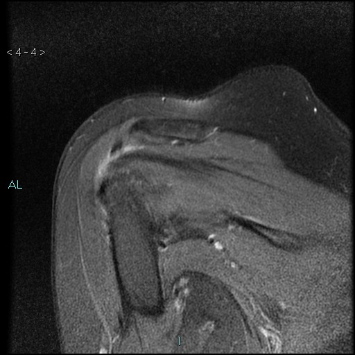File:Avascular necrosis of the shoulder - Cruess stage I (Radiopaedia 77674-89886 Coronal PD fat sat 4).jpg