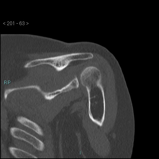Avascular necrosis of the shoulder - Cruess stage I (Radiopaedia 77674-89887 Coronal bone window 62).jpg