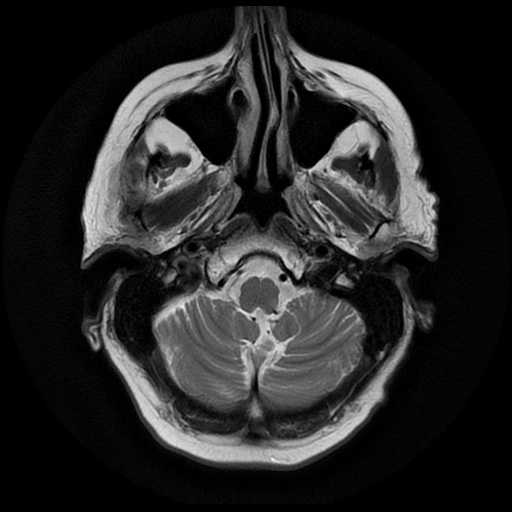 File:Balo concentric sclerosis (Radiopaedia 53875-59982 Axial T2 4).jpg