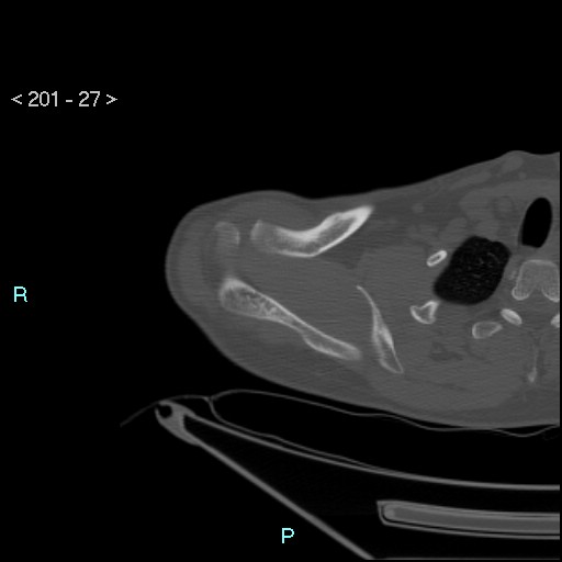 File:Bankart lesion with glenoid bone defect - assessment TC with PICO method (Radiopaedia 42855-93901 Axial bone window 26).jpg