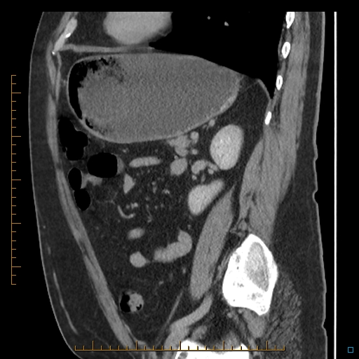 File:Bariatric balloon causing gastric outlet obstruction (Radiopaedia 54449-60672 C 28).jpg
