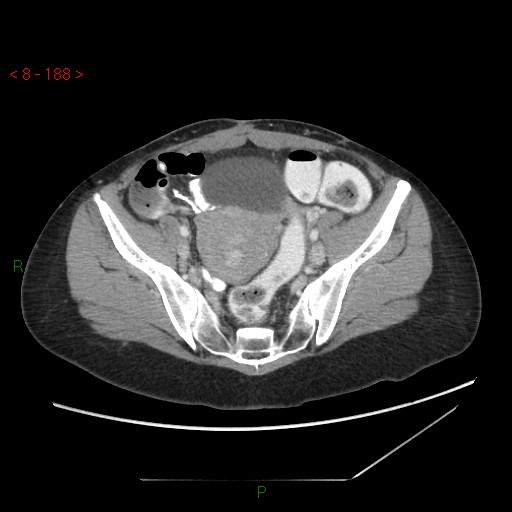 Bartholin gland cyst (Radiopaedia 54904-61181 A 47).jpg
