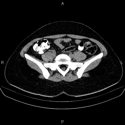Bartholin gland cyst (Radiopaedia 62635-70930 Axial non-contrast 14).jpg