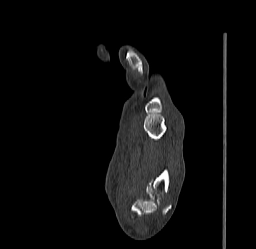 Base of 2nd metacarpal fracture (Radiopaedia 73741-84544 Sagittal bone window 58).jpg