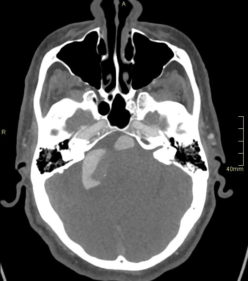 File:Basilar artery aneurysm (Radiopaedia 56261-62932 A 56).jpg