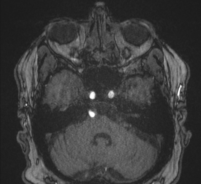 Basilar artery dissection (Radiopaedia 77032-88976 Axial TOF 49).jpg