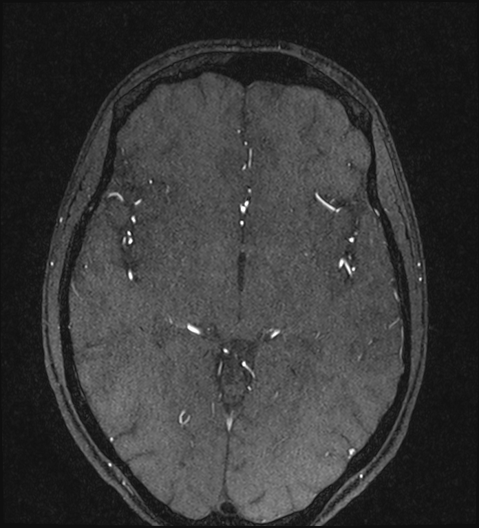 Basilar artery perforator aneurysm (Radiopaedia 82455-97733 Axial MRA 126).jpg