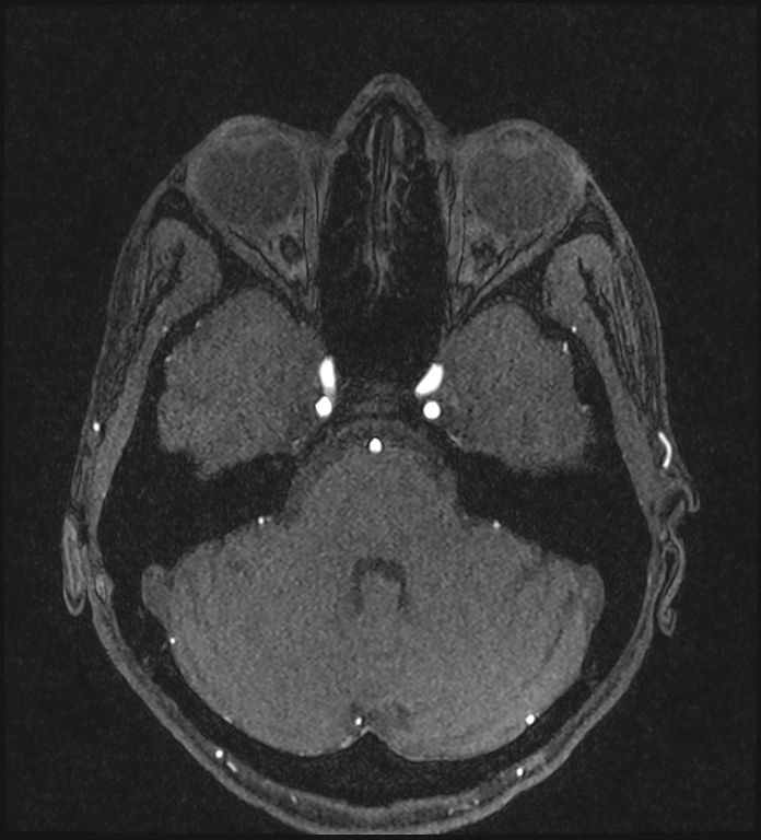 Basilar artery perforator aneurysm (Radiopaedia 82455-97733 Axial MRA 75).jpg