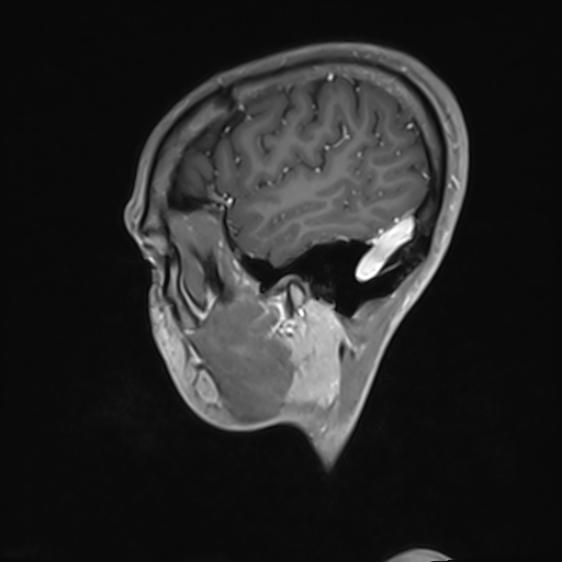 Basilar artery perforator aneurysm (Radiopaedia 82455-97733 G 26).jpg