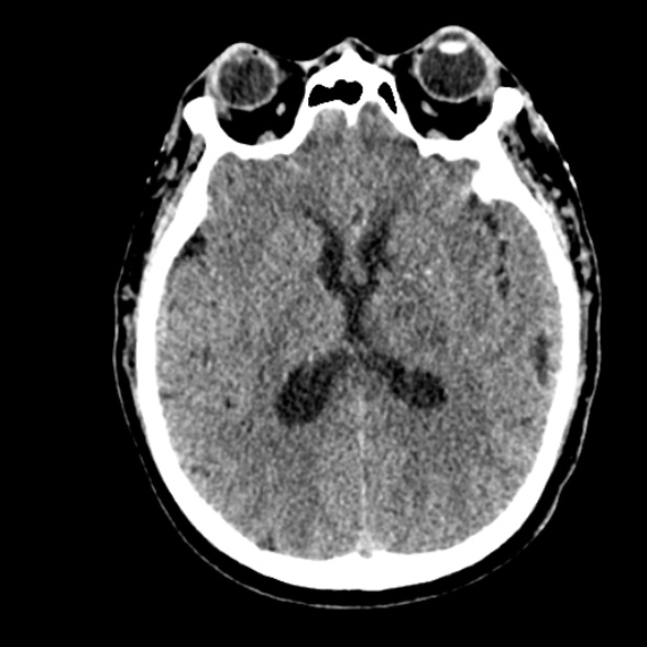 Basilar artery thrombosis (Radiopaedia 53351-59352 Axial non-contrast 66).jpg