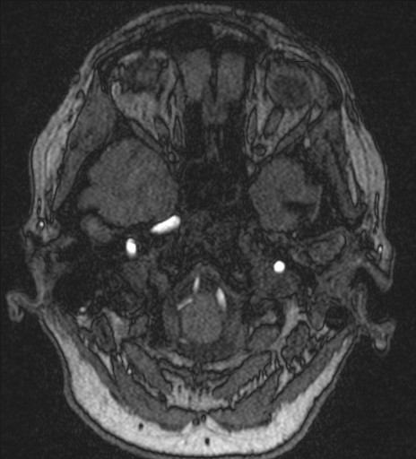 File:Basilar tip aneurysm (Radiopaedia 26504-26632 MRA 29).jpg