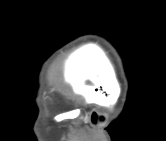 Basilar tip aneurysm with coiling (Radiopaedia 53912-60086 C 1).jpg