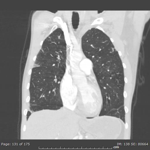 File:Behçet disease (Radiopaedia 44247-47889 Coronal lung window 41).jpg