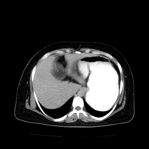 Benign spindle cell tumor - abdominopelvic (Radiopaedia 61300-69212 Axial C+ delayed 11).jpg