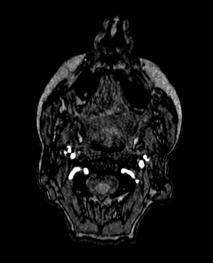 Berry aneurysm of the terminal internal carotid artery (Radiopaedia 88286-104918 Axial TOF 4).jpg