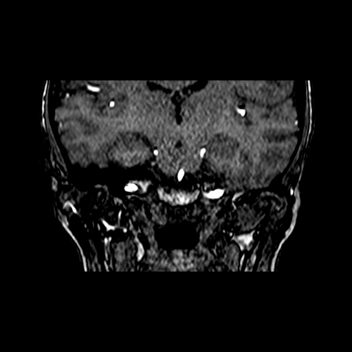File:Berry aneurysm of the terminal internal carotid artery (Radiopaedia 88286-104918 Coronal TOF 53).jpg