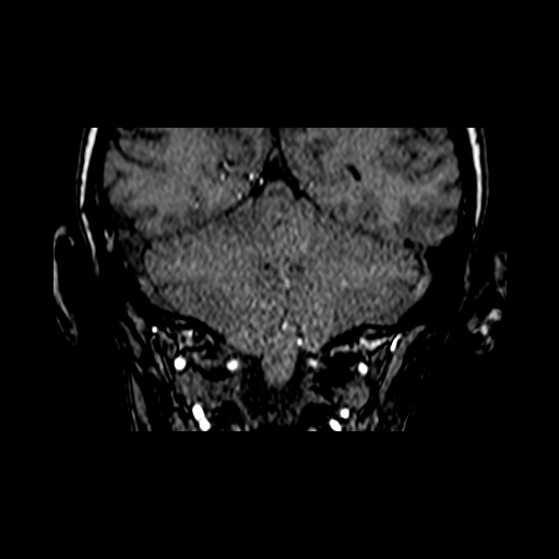 File:Berry aneurysm of the terminal internal carotid artery (Radiopaedia 88286-104918 Coronal TOF 85).jpg
