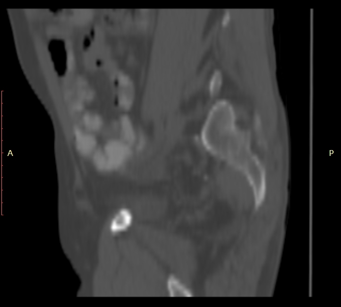 Bertolotti syndrome (Radiopaedia 58974-66235 Sagittal bone window 4).jpg