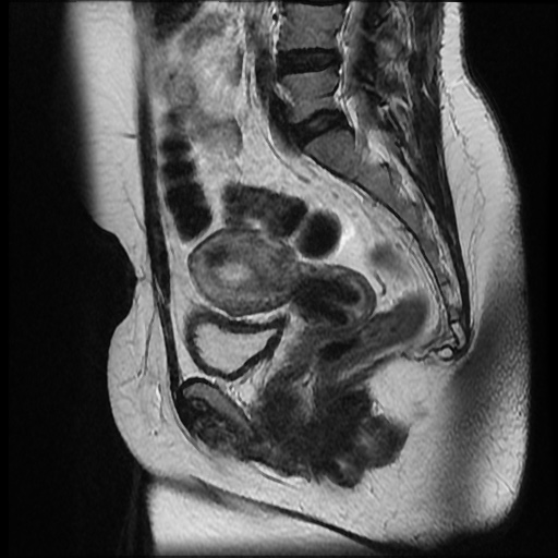 File:Bicornuate uterus (Radiopaedia 51676-57472 Sagittal T2 16).jpg