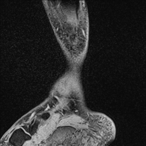 Bilateral Achilles tendon complete tear (Radiopaedia 81344-95051 Sagittal WE - Left 25).jpg