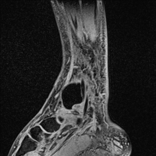 Bilateral Achilles tendon complete tear (Radiopaedia 81344-95051 Sagittal WE - Right 81).jpg