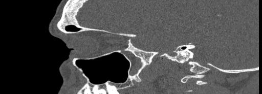 Bilateral Ectopic Infraorbital Nerves (Radiopaedia 49006-54084 Sagittal bone window 37).jpg