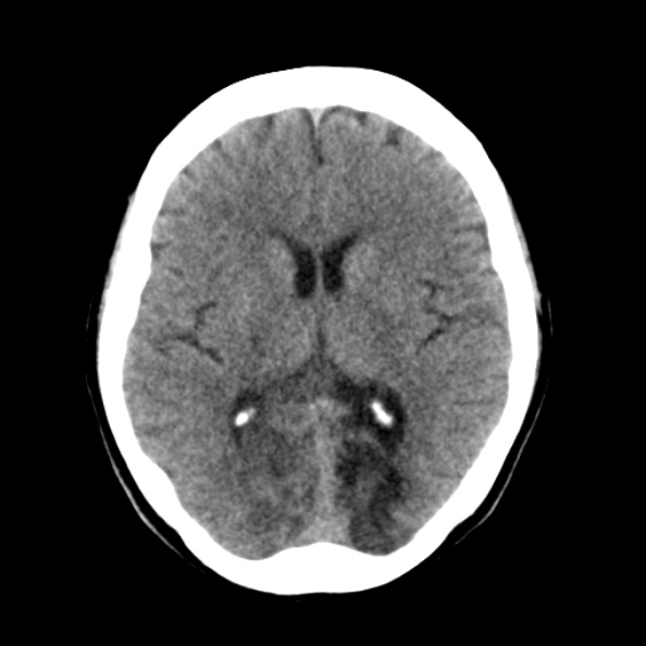 File:Bilateral PCA territory infarction - different ages (Radiopaedia 46200-50591 Axial non-contrast 12).jpg