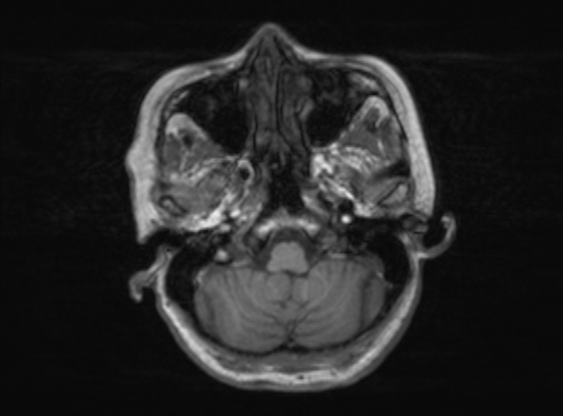 Bilateral PCA territory infarction - different ages (Radiopaedia 46200-51784 Axial T1 325).jpg