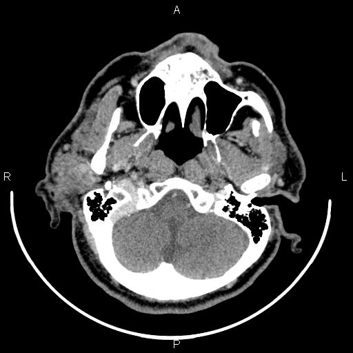 Bilateral Warthin tumors (Radiopaedia 84034-99263 Axial With contrast 12).jpg