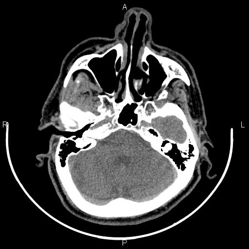 Bilateral Warthin tumors (Radiopaedia 84034-99263 Axial non-contrast 4).jpg