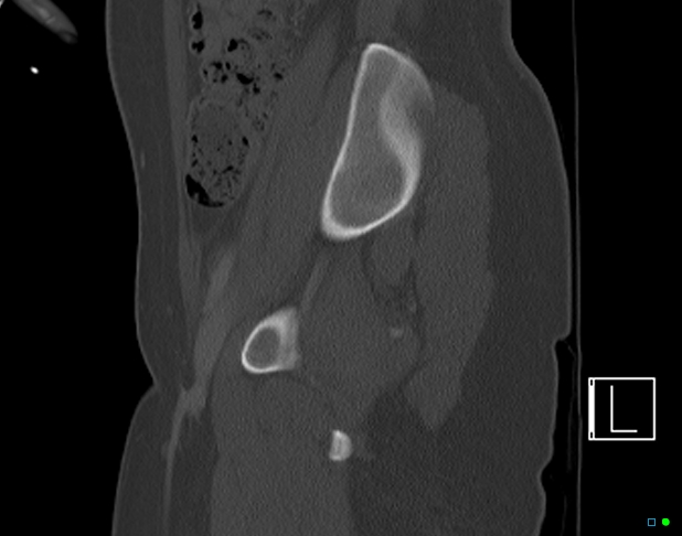 Bilateral acetabular fractures (Radiopaedia 79272-92308 Sagittal bone window 27).jpg