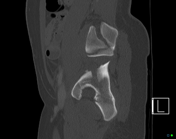 File:Bilateral acetabular fractures (Radiopaedia 79272-92308 Sagittal bone window 62).jpg