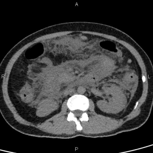 Bilateral adrenal gland hyperenhancement in pancreatitis (Radiopaedia 86642-102753 Axial non-contrast 52).jpg