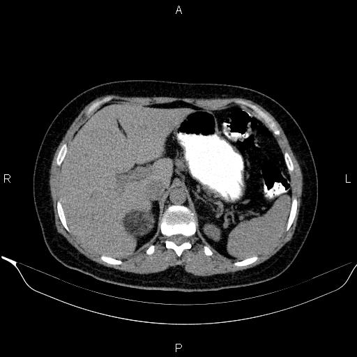 Bilateral adrenal myelolipoma (Radiopaedia 63058-71535 Axial non-contrast 40).jpg