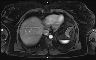 Bilateral adrenal myelolipoma (Radiopaedia 63058-71537 Axial T1 C+ fat sat 13).jpg
