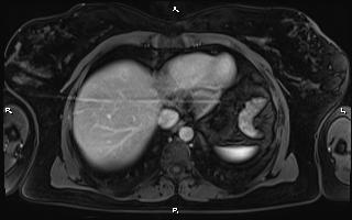 Bilateral adrenal myelolipoma (Radiopaedia 63058-71537 G 13).jpg