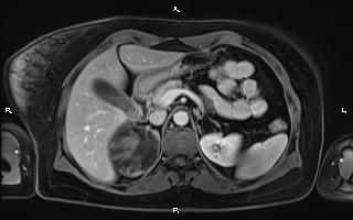 Bilateral adrenal myelolipoma (Radiopaedia 63058-71537 G 35).jpg