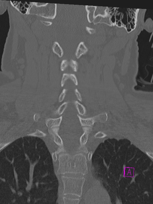 Bilateral atlanto-occipital assimilation (Radiopaedia 28350-28603 Coronal bone window 26).jpg