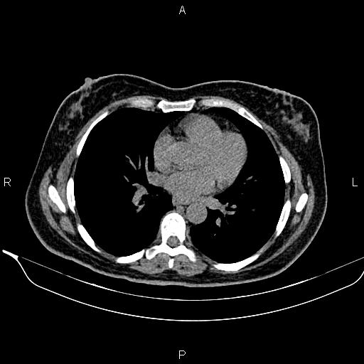 Bilateral benign adrenal adenomas (Radiopaedia 86912-103124 Axial non-contrast 4).jpg