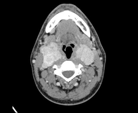 File:Bilateral carotid body tumors (Radiopaedia 61841-69870 Axial Post contrast 47).jpg