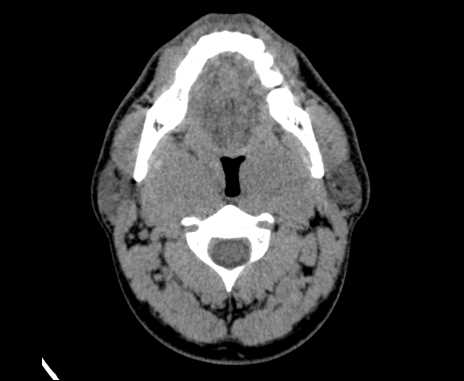 Bilateral carotid body tumors (Radiopaedia 61841-69870 Axial non-contrast 34).jpg