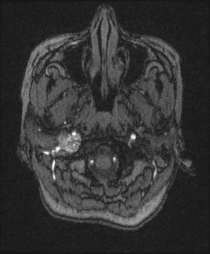 Bilateral carotid body tumors and right glomus jugulare tumor (Radiopaedia 20024-20060 Axial MRA 15).jpg